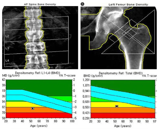 Imagen Destacada - Osteoprosis. DEXA