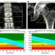 Imagen Destacada - Osteoprosis. DEXA