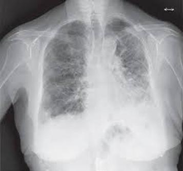 Imagen Destacada - Enfermedad pulmonar intersticial