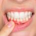 Imagen Destacada - Infecciones dentales. Profilaxis