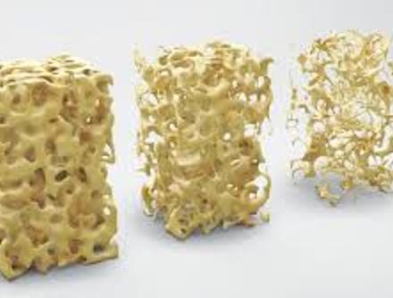 Imagen Destacada - Osteoporosis 2026