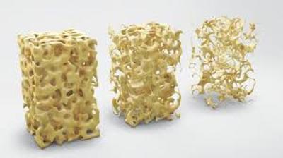 Imagen Destacada - Osteoporosis