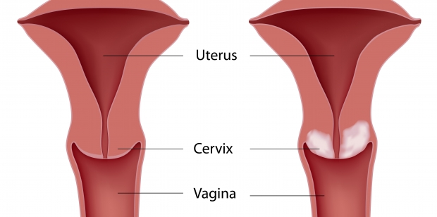 Imagen Destacada - Cáncer de cervix
